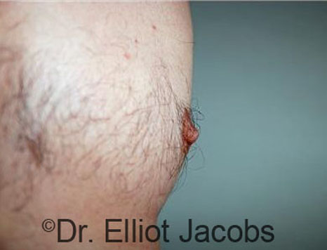 Male nipple, after Puffy Nipple treatment, side view - patient 42