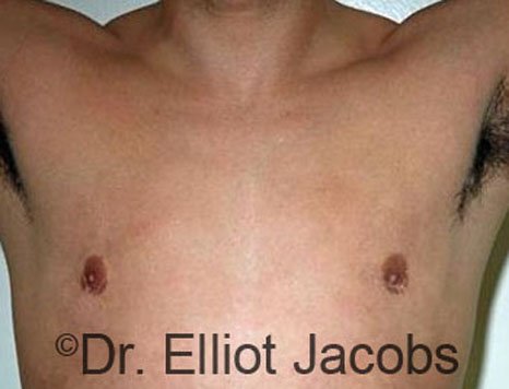 Men's breast, after Crater Deformity Repair treatment, front view - patient 1
