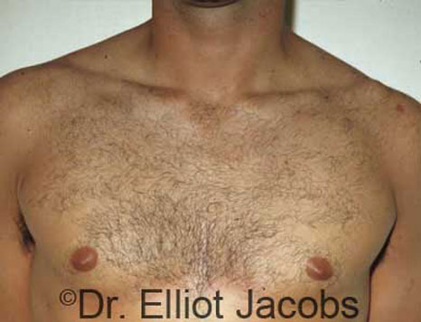 Male breast, after Gynecomastia treatment, front view, patient 21