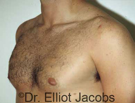Male breast, after Gynecomastia treatment, l-side oblique view - patient 21