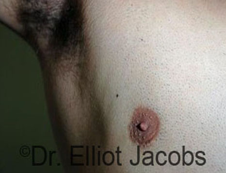 Men's breast, after Crater Deformity Repair treatment, front view - patient 2