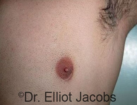 Men's breast, after Crater Deformity Repair treatment, front view, patient 2