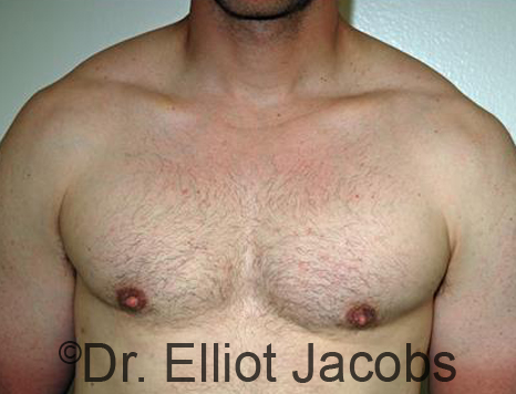 Men's breast, after Gynecomastia treatment in Bodybuilders, front view - patient 24