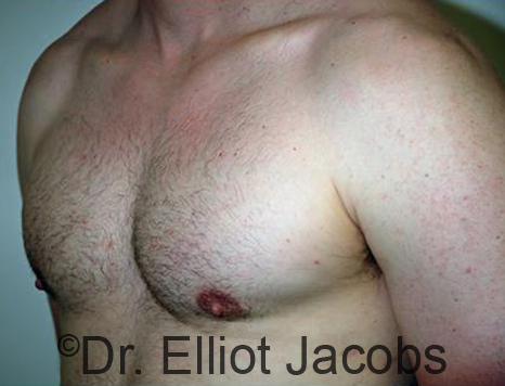 Men's breast, after Gynecomastia treatment in Bodybuilders, oblique view - patient 24