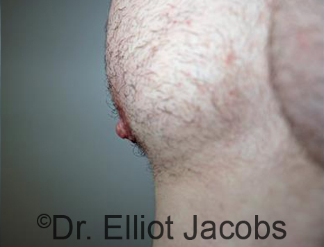 Male nipple, after Puffy Nipple treatment, r-side oblique view - patient 25