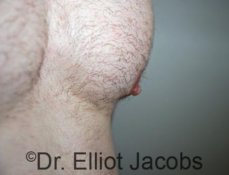 Male nipple, after Puffy Nipple treatment, l-side oblique view - patient 25