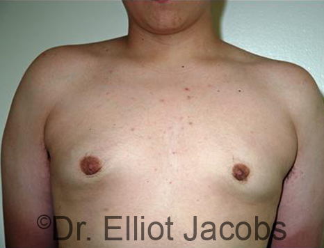 Men's breast, after Gynecomastia Adolescent treatment, front view - patient 28