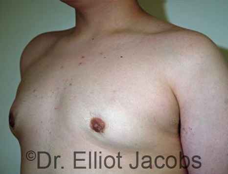 Men's breast, after Gynecomastia Adolescent treatment, oblique view - patient 28