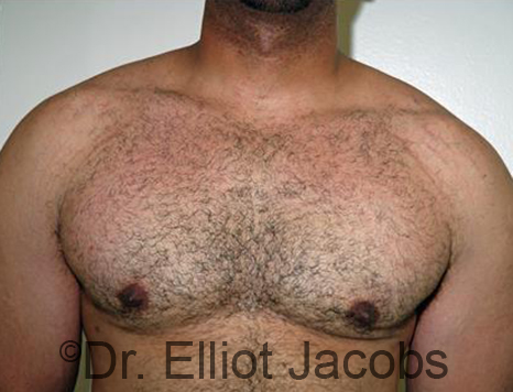 Men's breast, after Gynecomastia treatment in Bodybuilders, front view - patient 25