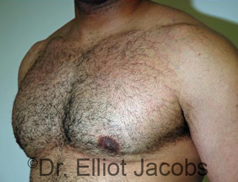 Men's breast, after Gynecomastia treatment in Bodybuilders, oblique view - patient 25
