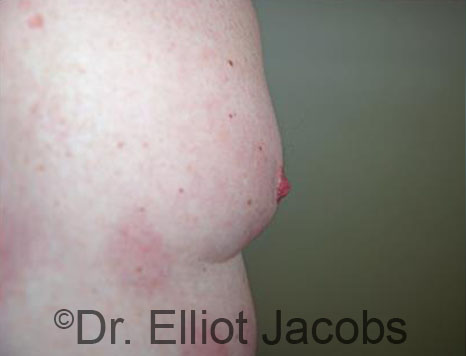 Male nipple, after Puffy Nipple treatment, oblique view - patient 44