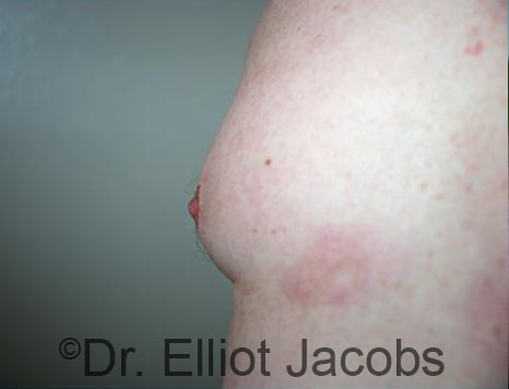 Male nipple, after Puffy Nipple treatment, side view - patient 44