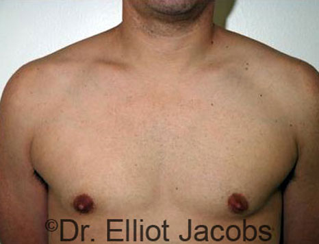 Male breast, after Gynecomastia treatment, front view, patient 22