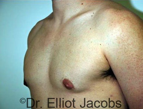Male breast, after Gynecomastia treatment, l-side oblique view - patient 22