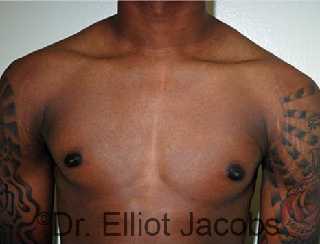 Men's breast, after Gynecomastia Adolescent treatment, front view - patient 29