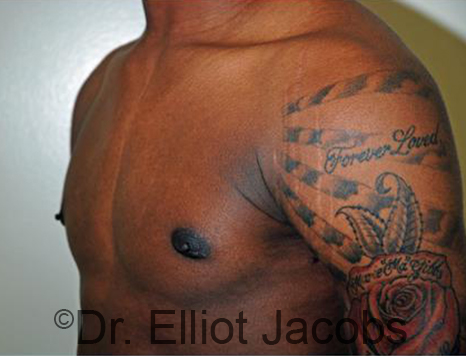 Men's breast, after Gynecomastia Adolescent treatment, oblique view - patient 29