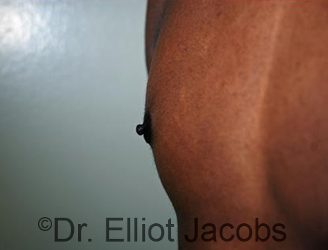 Male nipple, after Puffy Nipple treatment, l-side oblique view - patient 26
