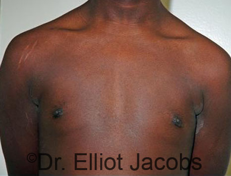 Men's breast, after Gynecomastia Adolescent treatment, front view - patient 30