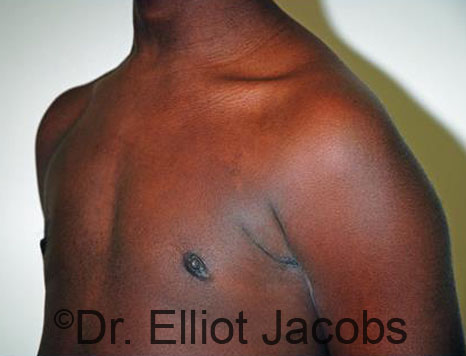 Men's breast, after Gynecomastia Adolescent treatment, oblique view - patient 30