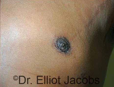 Men's breast, after Crater Deformity Repair treatment, front view - patient 3