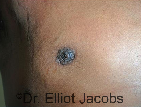 Men's breast, after Crater Deformity Repair treatment, front view, patient 3