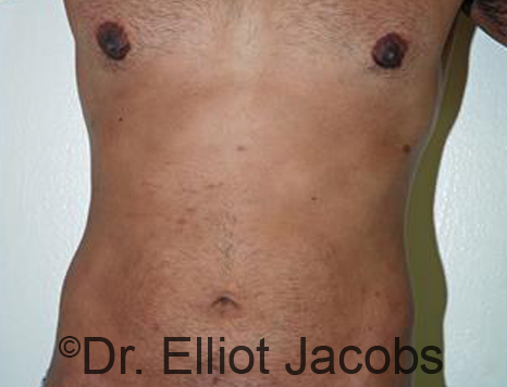 Male body, after Torsoplasty treatment, front view, patient 23