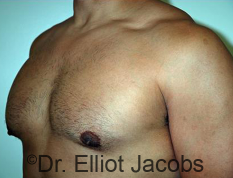 Male body, after Torsoplasty treatment, l-side oblique view, patient 23