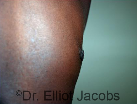 Male nipple, after Puffy Nipple treatment, r-side oblique view - patient 27