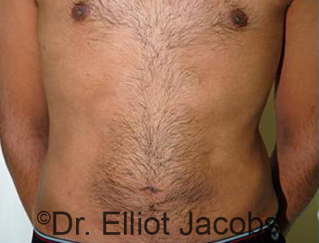 Male body, after Torsoplasty treatment, front view, patient 24