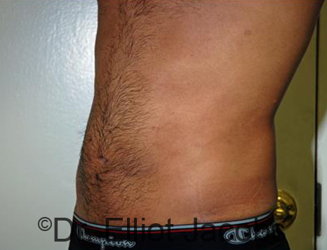 Male body, after Torsoplasty treatment, l-side oblique view, patient 24