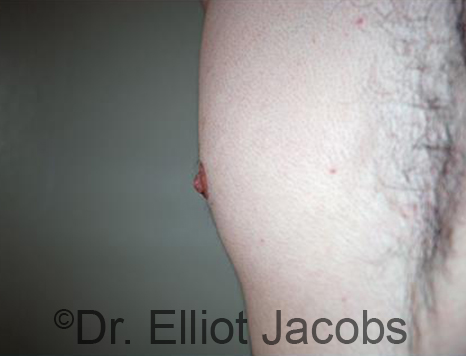 Male nipple, after Puffy Nipple treatment, oblique view - patient 45