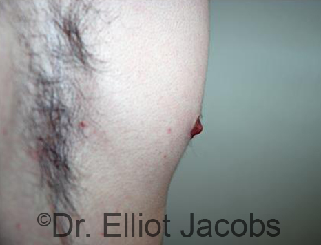 Male nipple, after Puffy Nipple treatment, side view - patient 45