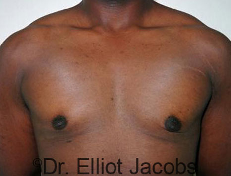 Male breast, after Gynecomastia treatment, front view, patient 23