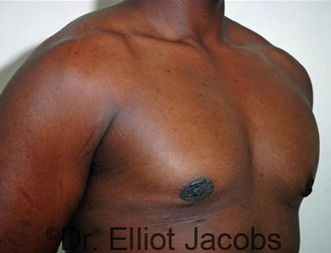 Male breast, after Gynecomastia treatment, r-side oblique view - patient 23