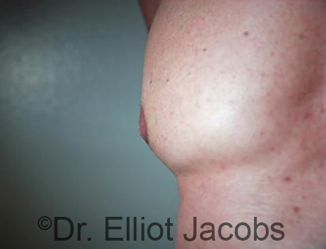 Male nipple, after Puffy Nipple treatment, side view - patient 46