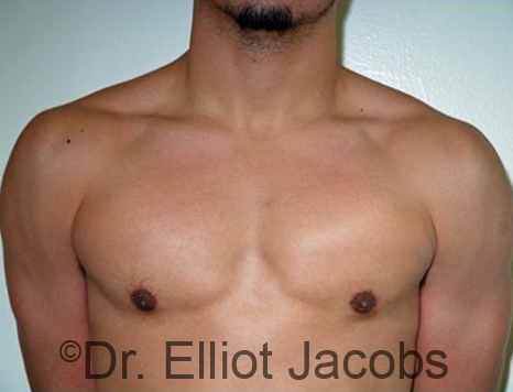 Men's breast, after Gynecomastia Adolescent treatment, front view - patient 31