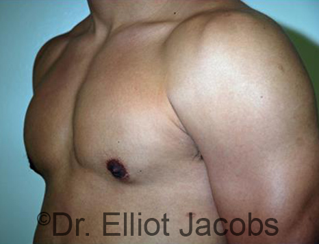 Men's breast, after Gynecomastia Adolescent treatment, oblique view - patient 31