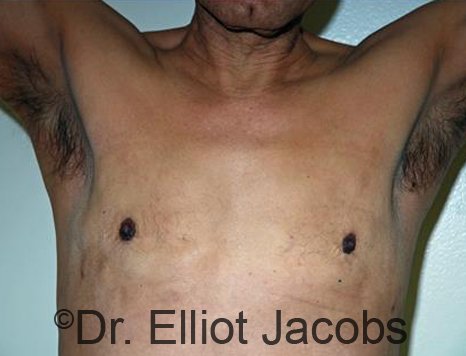 Men's breast, after Revision Gynecomastia treatment, front view - patient 1