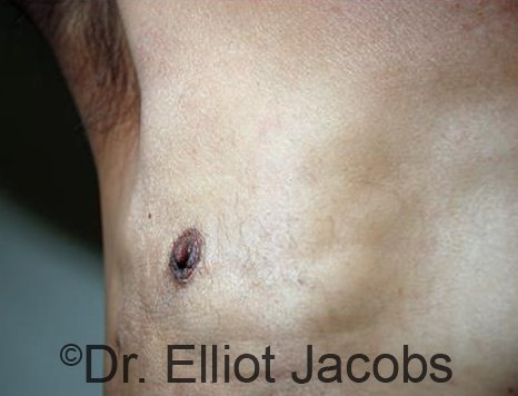 Men's nipple, after Revision Gynecomastia treatment, front view - patient 1