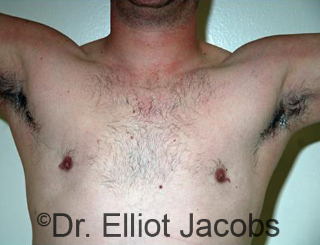 Men's breast, after Revision Gynecomastia treatment, front view - patient 2