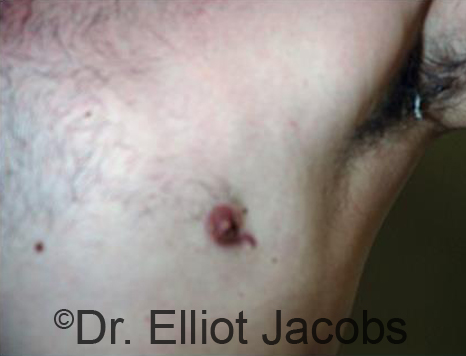 Men's nipple, after Revision Gynecomastia treatment, front view - patient 2