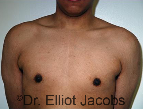 Male breast, after Gynecomastia treatment, front view, patient 87