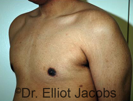 Male breast, after Gynecomastia treatment, l-side oblique view - patient 87