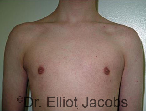 Men's breast, after Gynecomastia Adolescent treatment, front view - patient 32