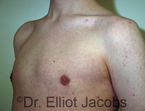 Men's breast, after Gynecomastia Adolescent treatment, oblique view - patient 32