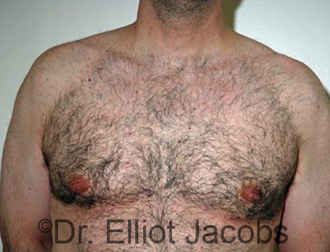 Male breast, after Gynecomastia treatment, front view, patient 88