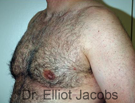 Male breast, after Gynecomastia treatment, l-side oblique view - patient 88