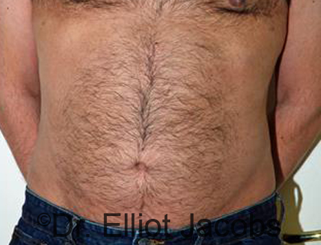 Male body, after Puffy Nipple Reduction treatment, front view, patient 3