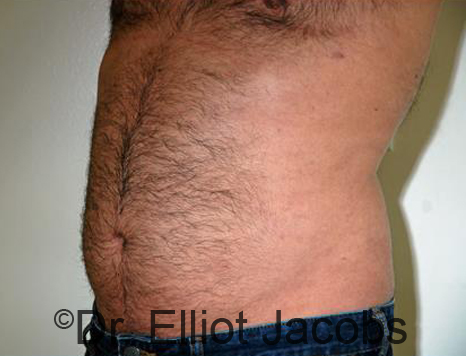 Male body, after Torsoplasty treatment, l-side oblique view, patient 25