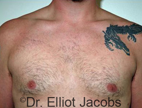 Male breast, after Gynecomastia treatment, front view, patient 24